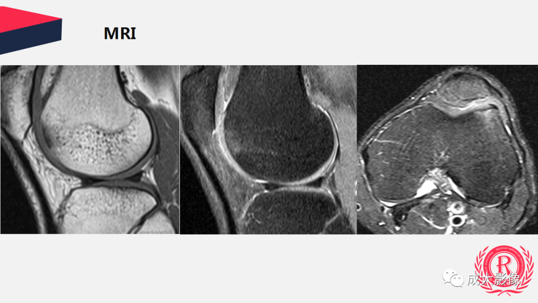 【PPT】剥脱性骨软骨炎-21