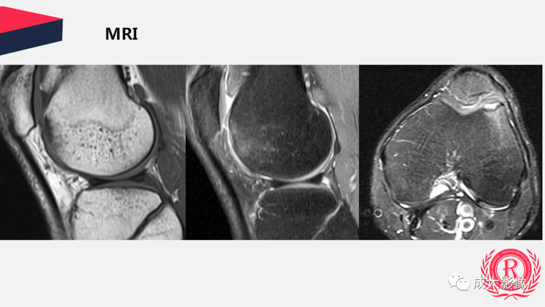 【PPT】剥脱性骨软骨炎-22