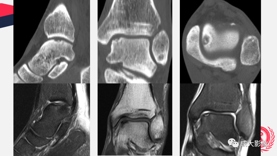 【PPT】剥脱性骨软骨炎-23
