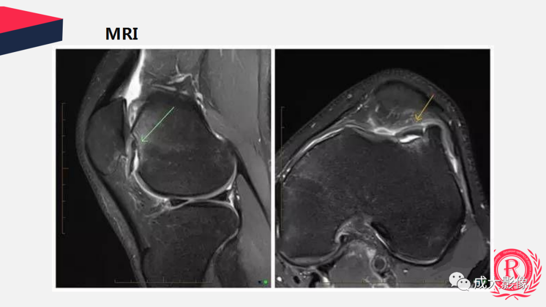 【PPT】剥脱性骨软骨炎-24