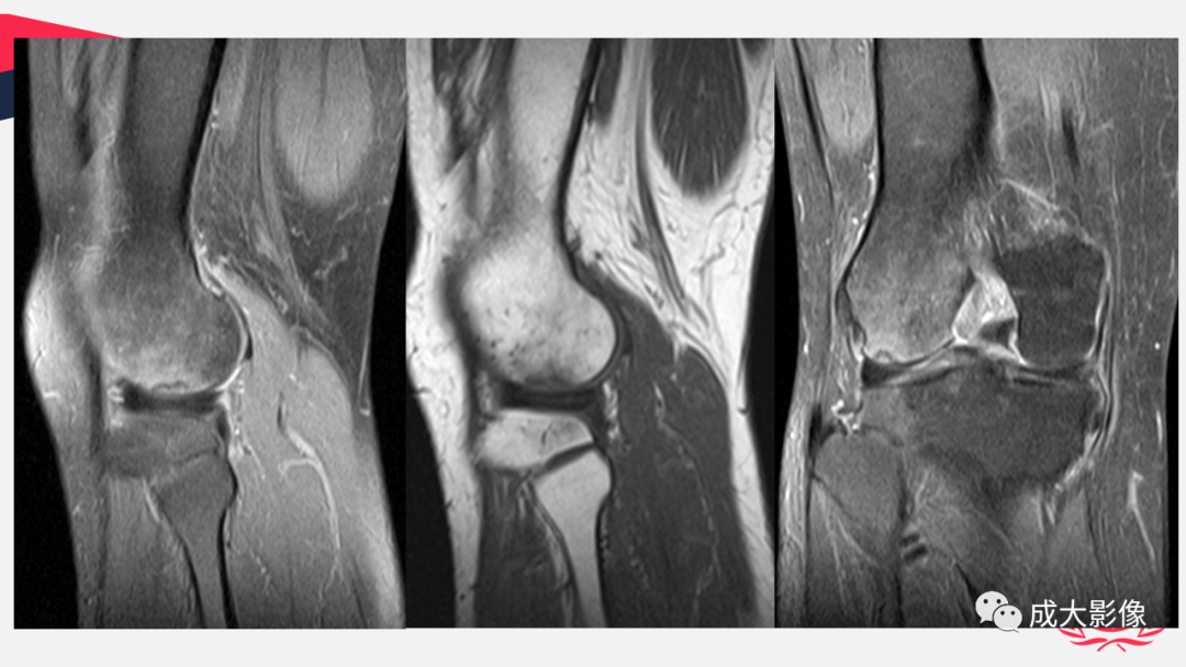 【PPT】剥脱性骨软骨炎-27