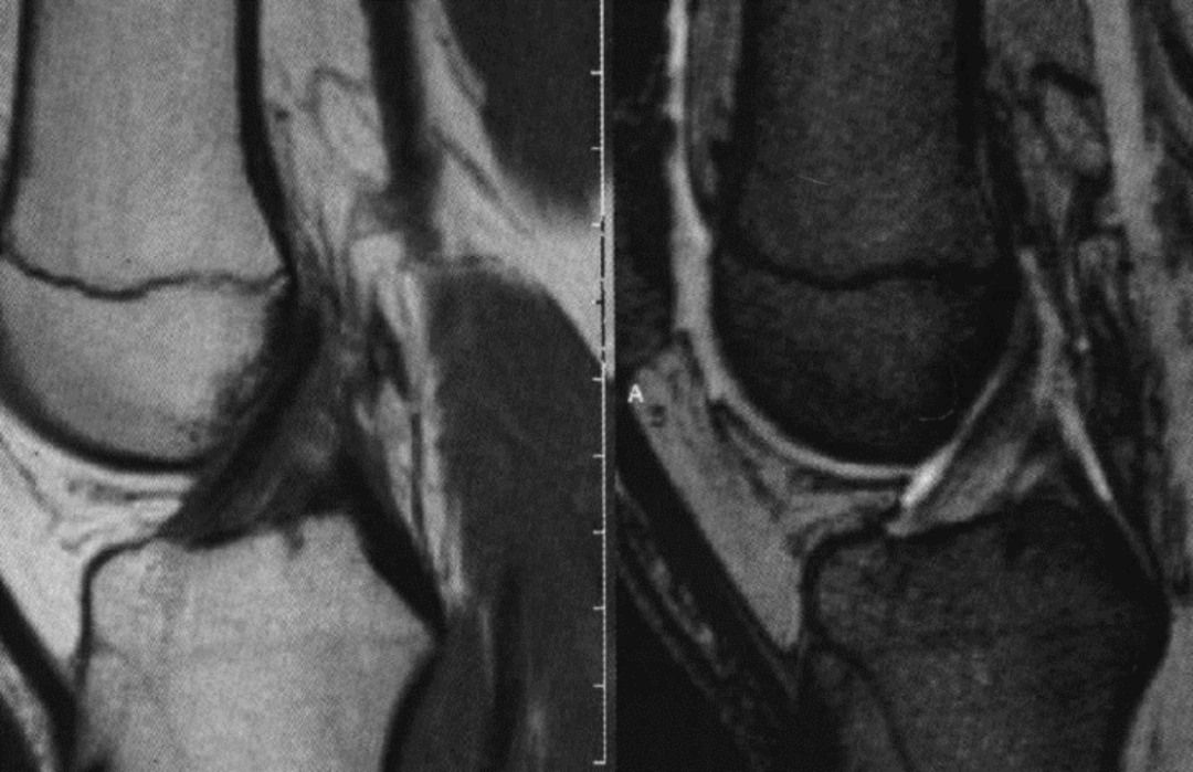 前交叉韧带MRI怎么看-2 前交叉韧带MRI怎么看-2