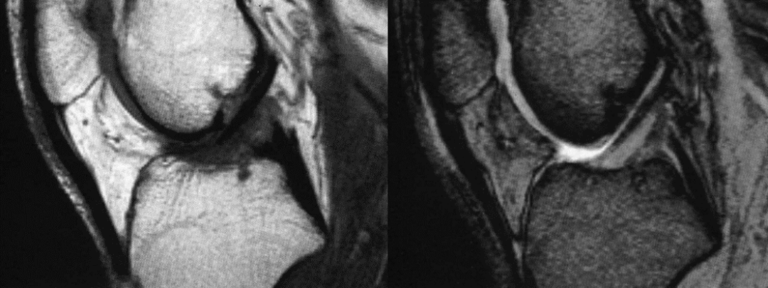 前交叉韧带MRI怎么看-1 前交叉韧带MRI怎么看-1