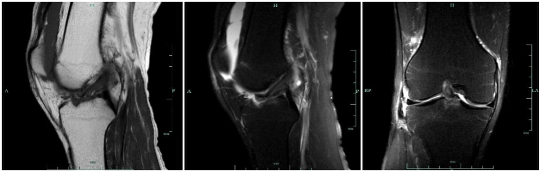 前交叉韧带MRI怎么看-4 前交叉韧带MRI怎么看-4