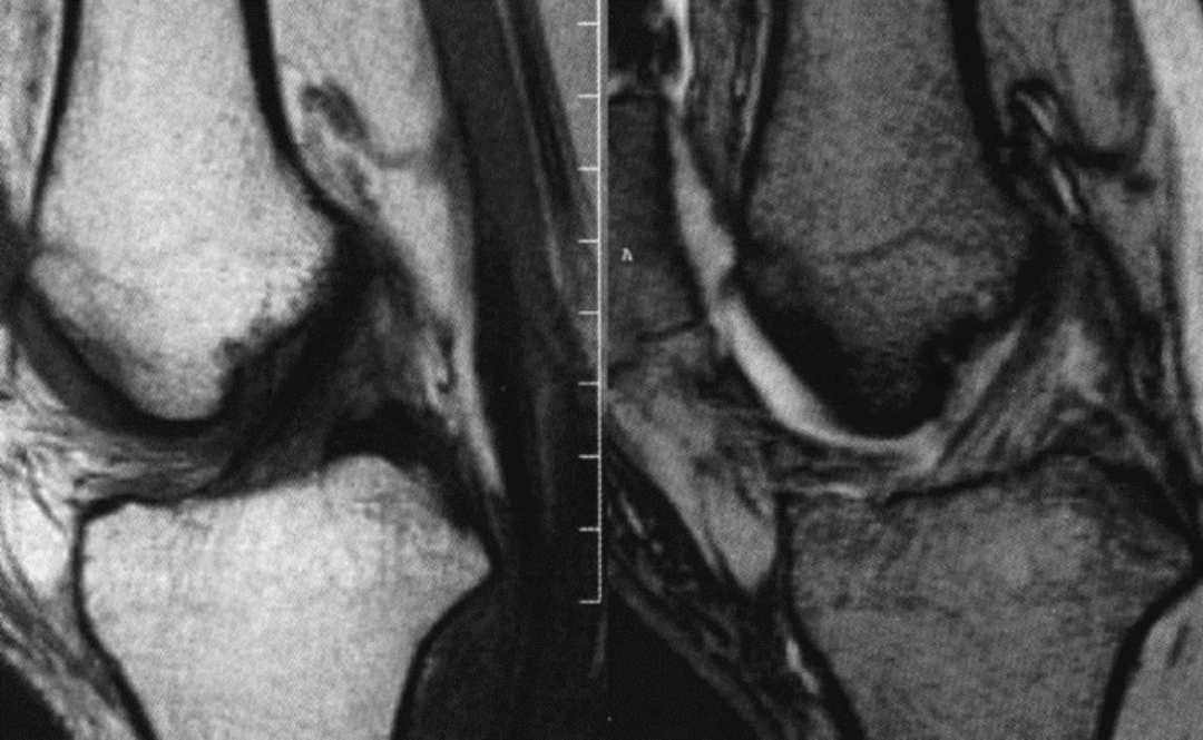 前交叉韧带MRI怎么看-3 前交叉韧带MRI怎么看-3