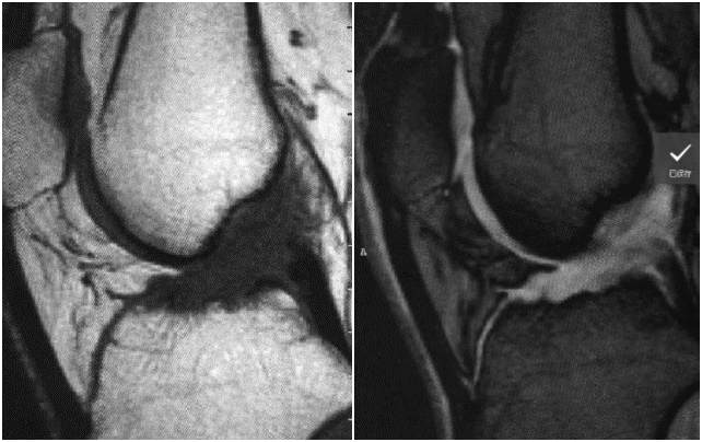 前交叉韧带MRI怎么看-7 前交叉韧带MRI怎么看-7