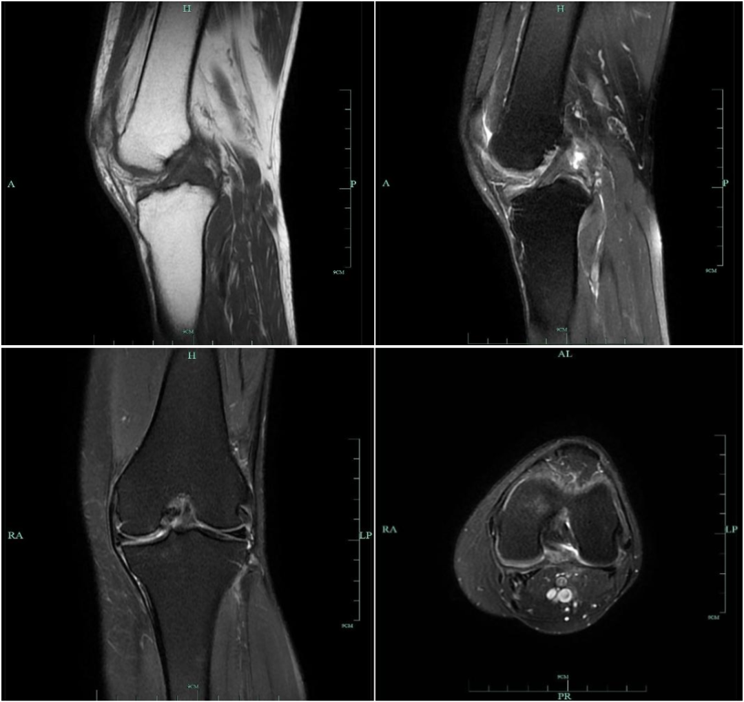 前交叉韧带MRI怎么看-6 前交叉韧带MRI怎么看-6