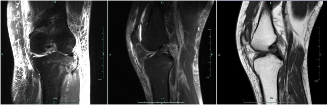 前交叉韧带MRI怎么看-8 前交叉韧带MRI怎么看-8