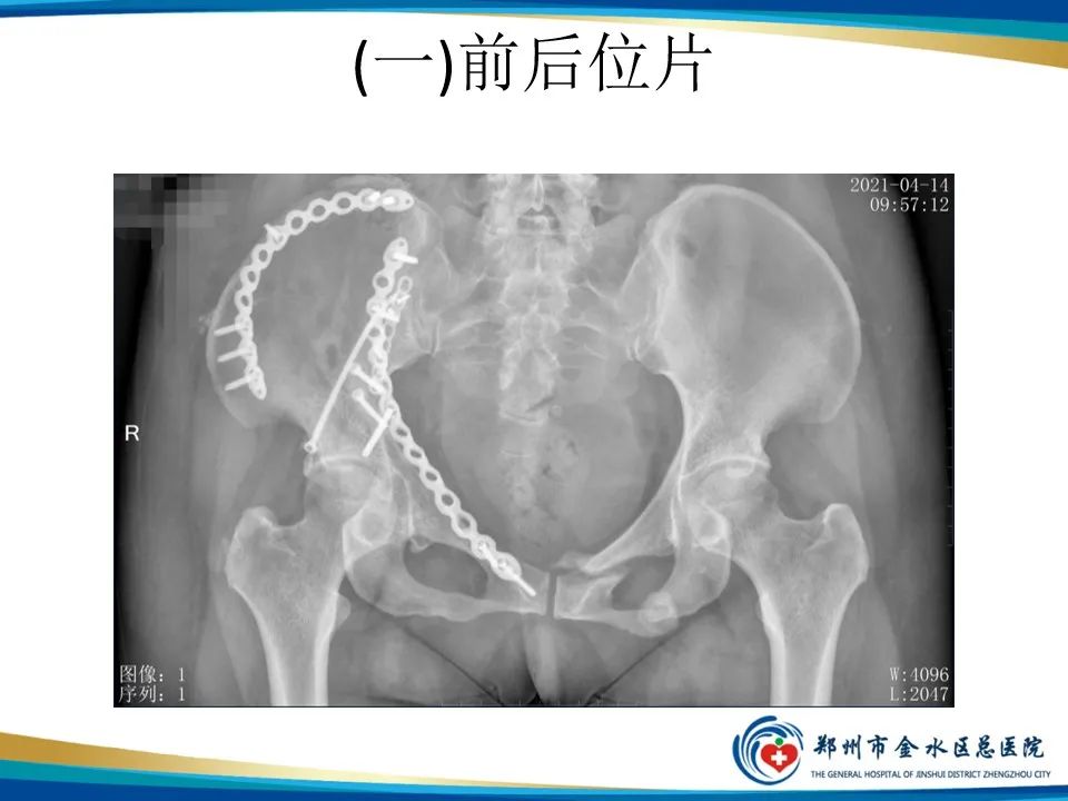 【PPT】骨盆拍片技术与临床意义-8