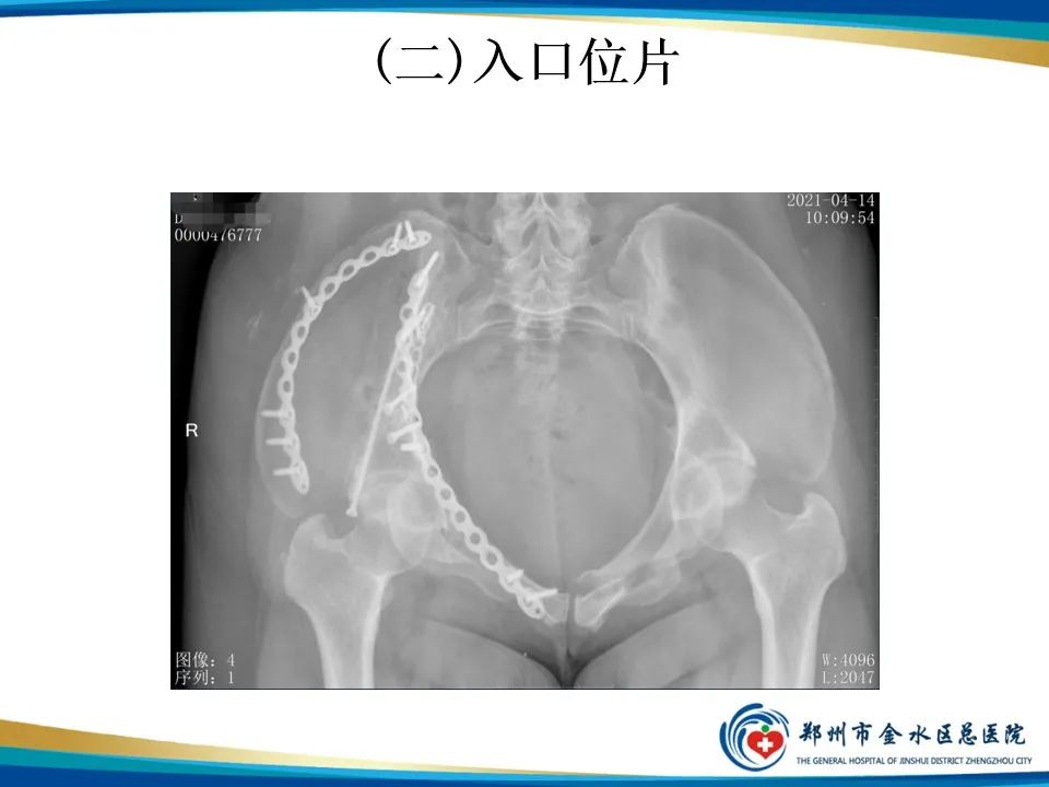 【PPT】骨盆拍片技术与临床意义-12