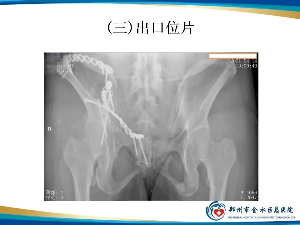 【PPT】骨盆拍片技术与临床意义-16