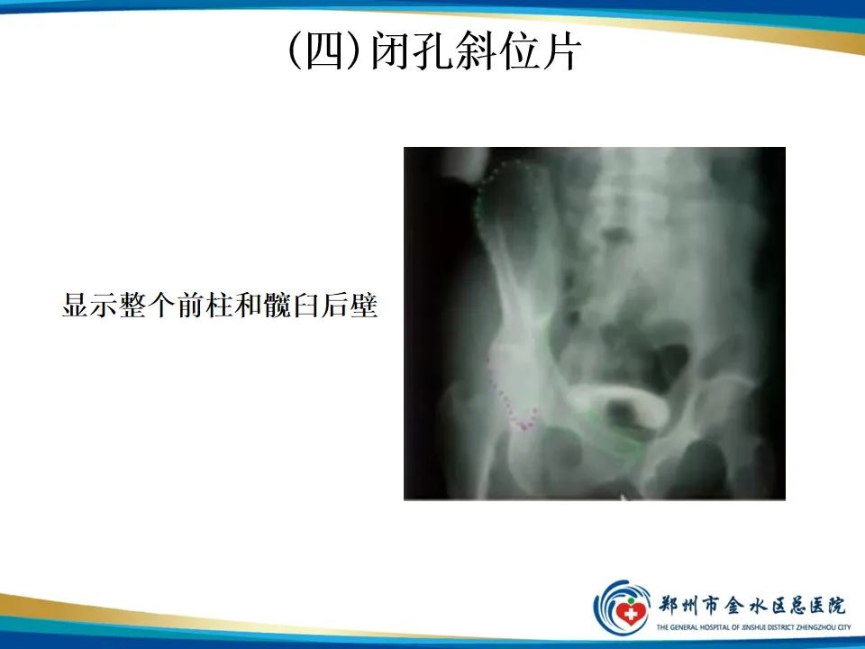 【PPT】骨盆拍片技术与临床意义-18