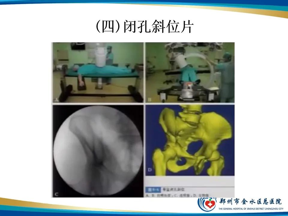【PPT】骨盆拍片技术与临床意义-19