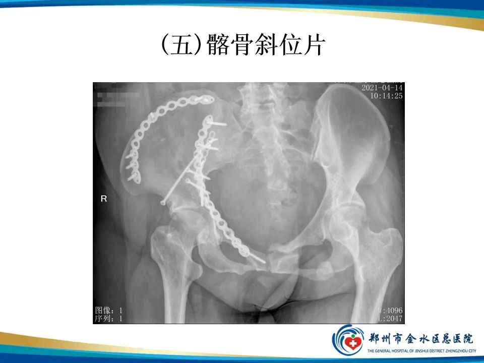 【PPT】骨盆拍片技术与临床意义-24