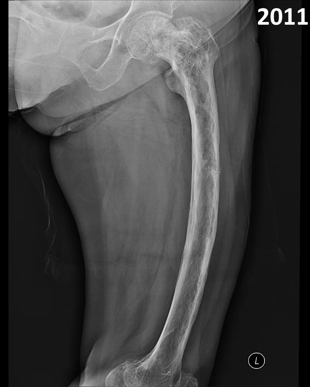 【病例】股骨Paget病伴病理性骨折1例X线-3