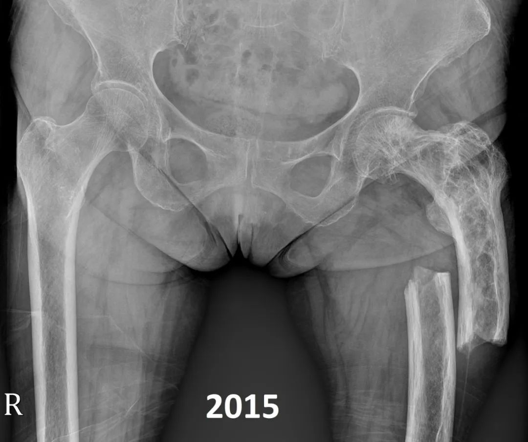 【病例】股骨Paget病伴病理性骨折1例X线-4