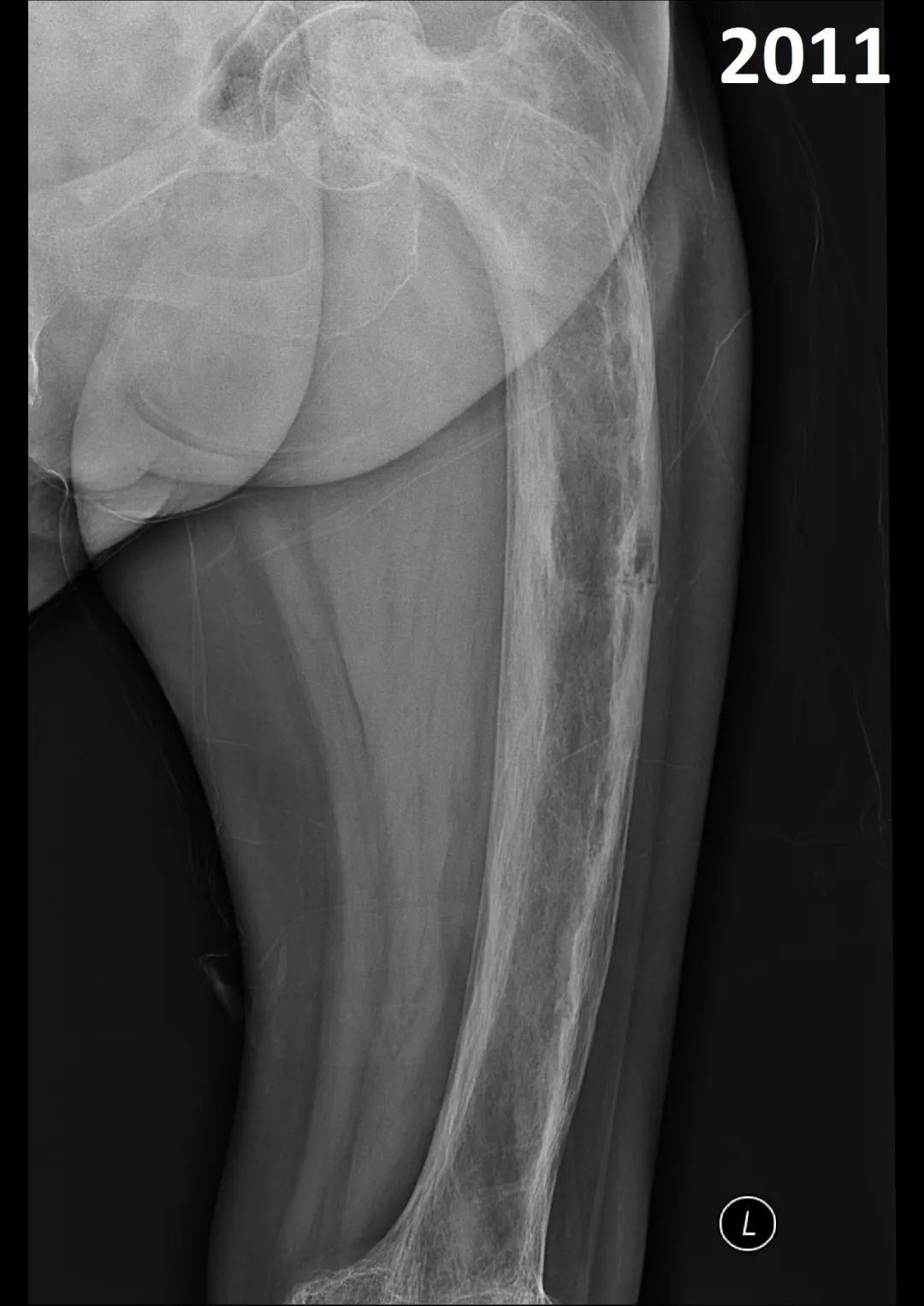【病例】股骨Paget病伴病理性骨折1例X线-2
