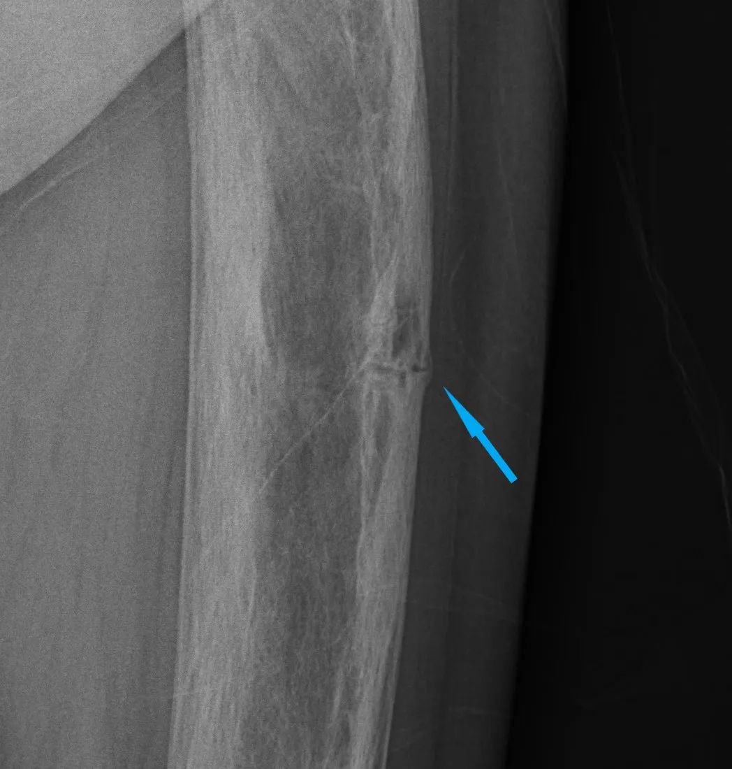 【病例】股骨Paget病伴病理性骨折1例X线-5