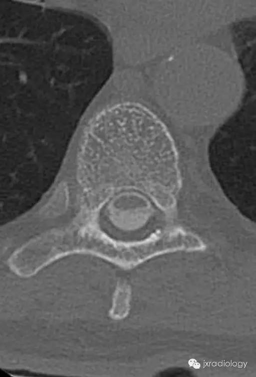 【病例】手术刀征—背侧蛛网膜网带1例MR影像-4