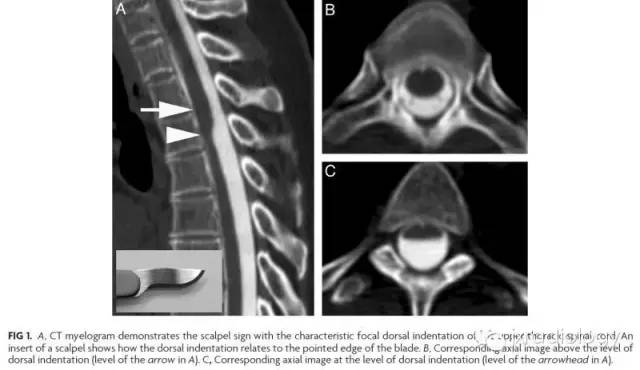 【病例】手术刀征—背侧蛛网膜网带1例MR影像-5