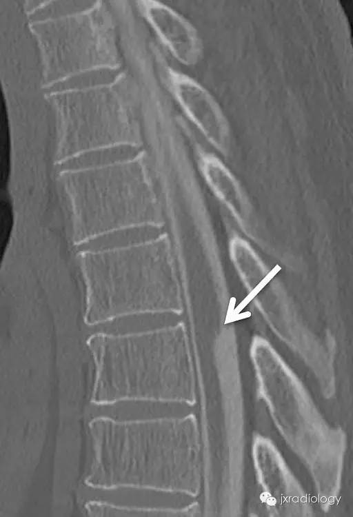 【病例】手术刀征—背侧蛛网膜网带1例MR影像-3