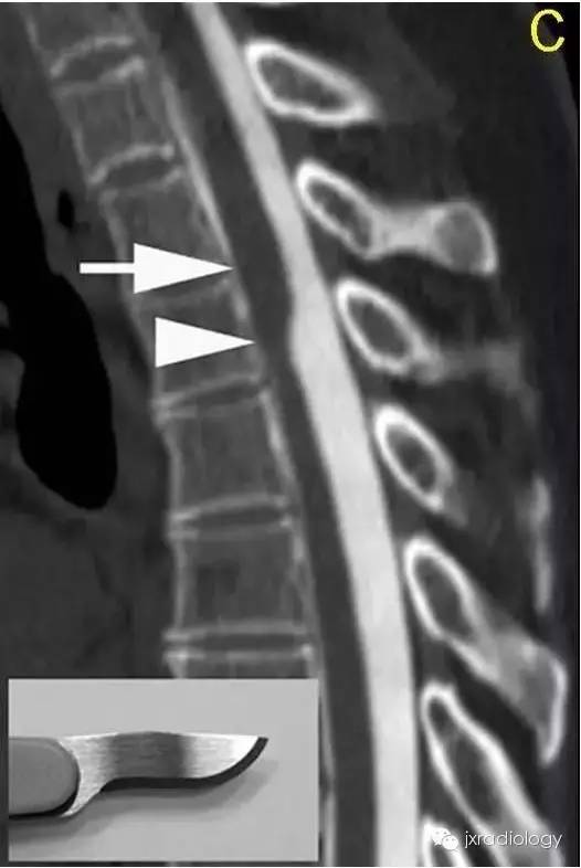 【病例】手术刀征—背侧蛛网膜网带1例MR影像-6