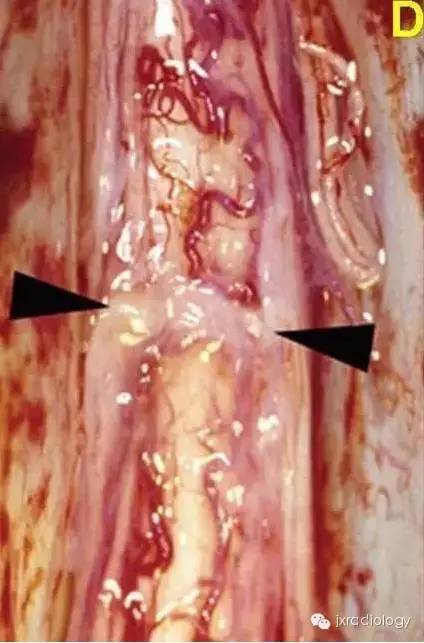 【病例】手术刀征—背侧蛛网膜网带1例MR影像-7