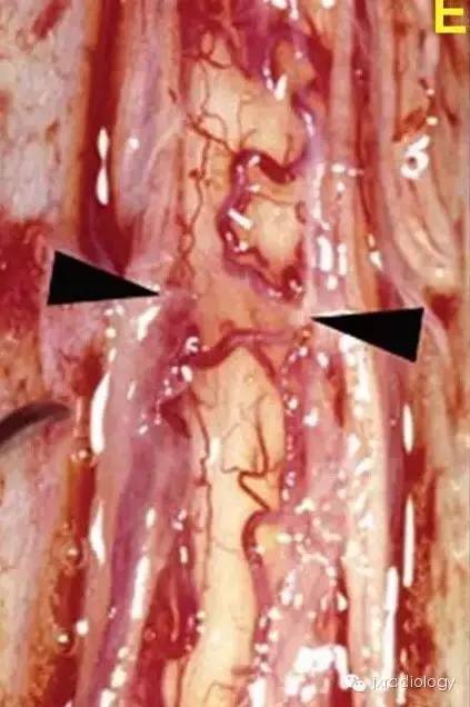 【病例】手术刀征—背侧蛛网膜网带1例MR影像-8