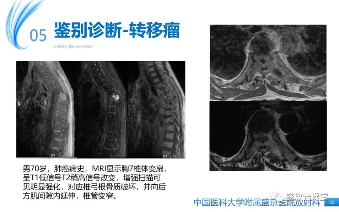 【PPT】孤立性浆细胞瘤-25