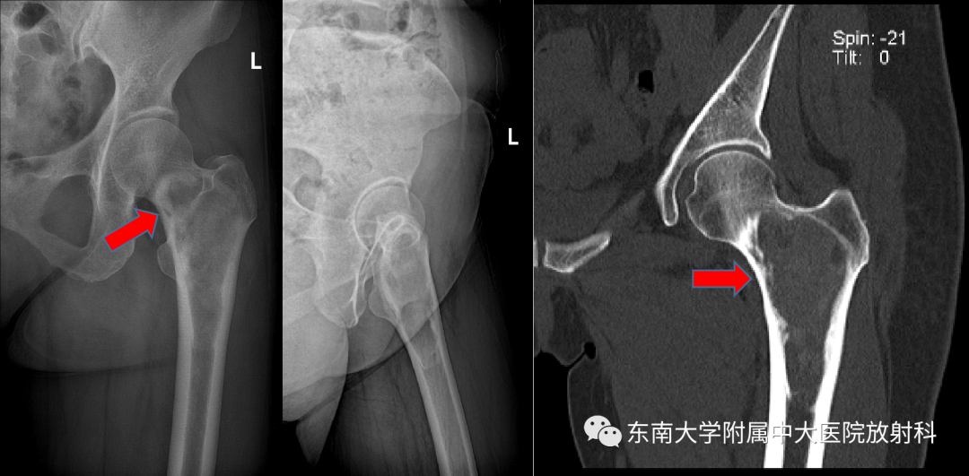 【PPT】骨纤维异常增殖症-1