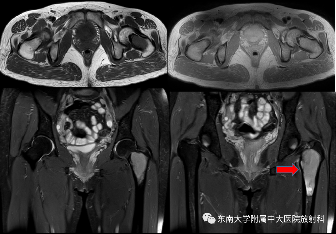 【PPT】骨纤维异常增殖症-2