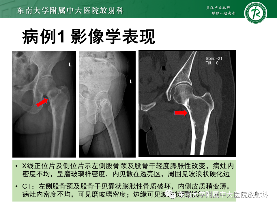 【PPT】骨纤维异常增殖症-3