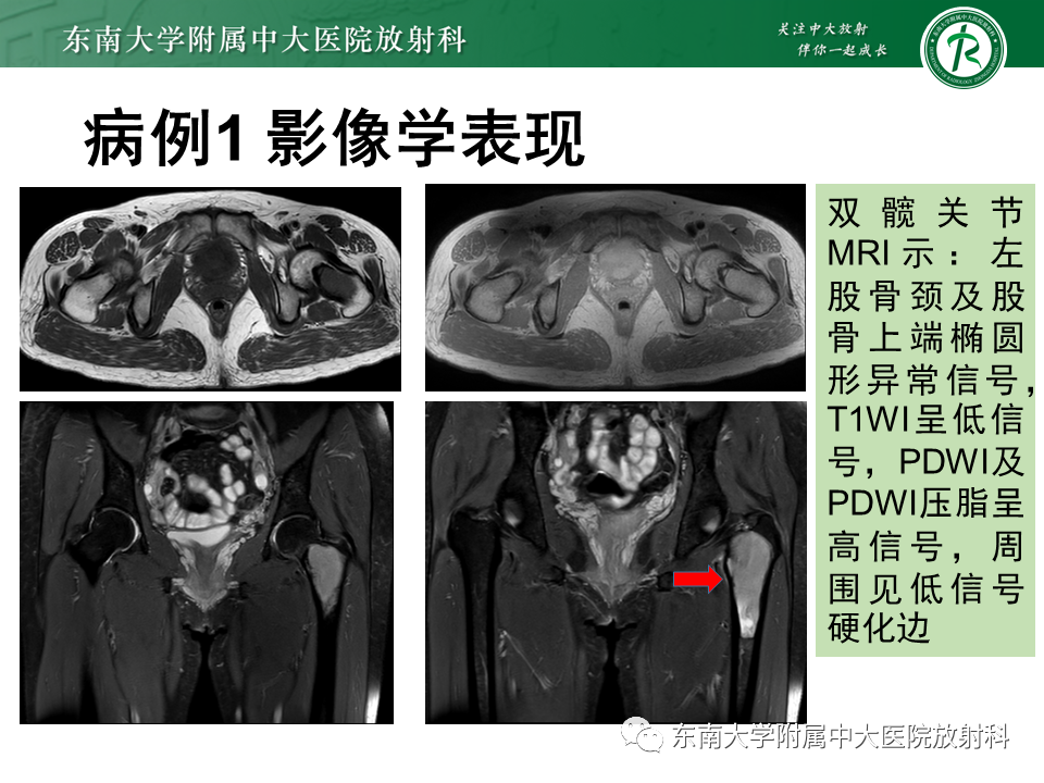 【PPT】骨纤维异常增殖症-4
