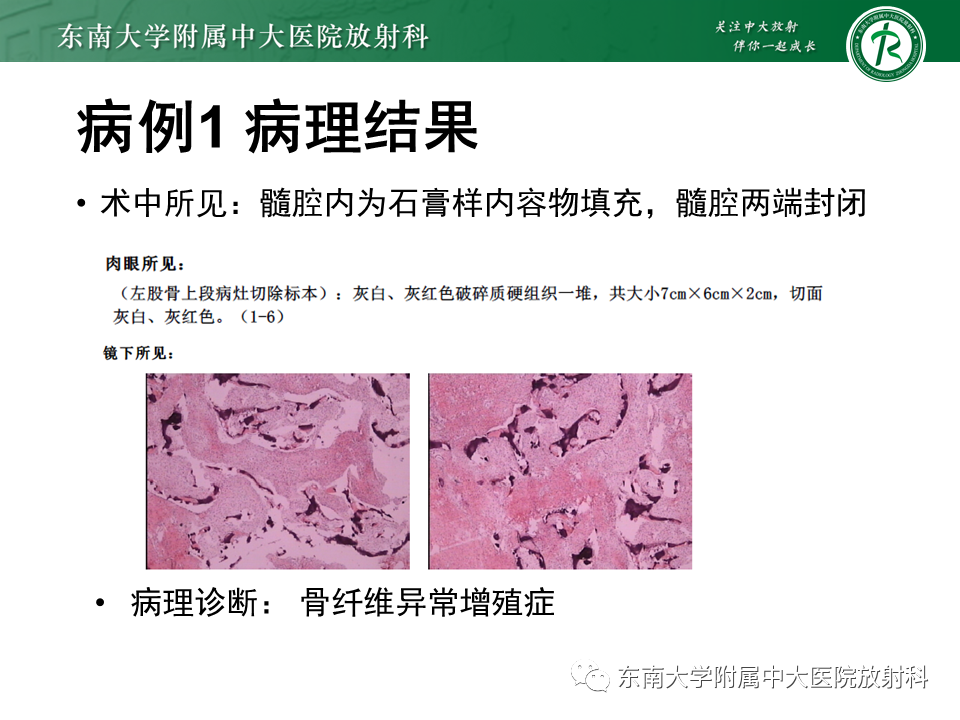 【PPT】骨纤维异常增殖症-5