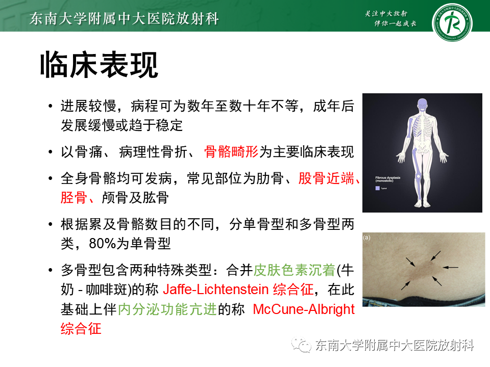 【PPT】骨纤维异常增殖症-9