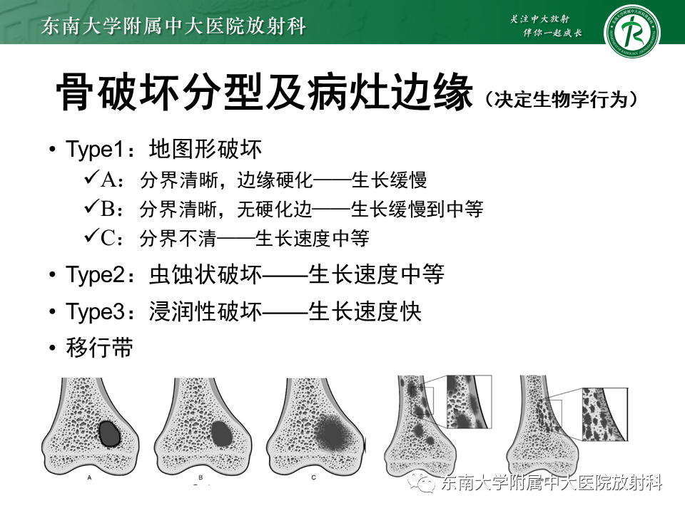 【PPT】骨纤维异常增殖症-10
