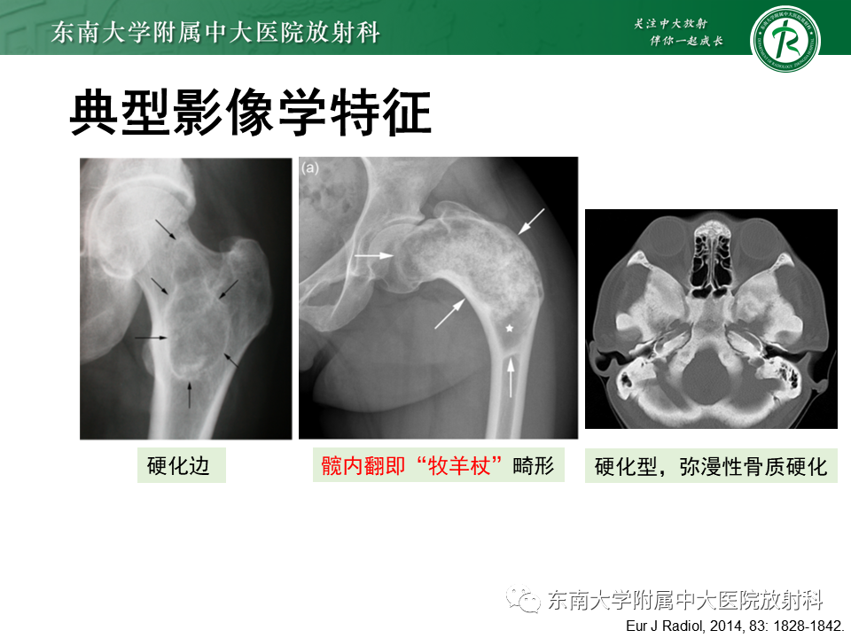 【PPT】骨纤维异常增殖症-13