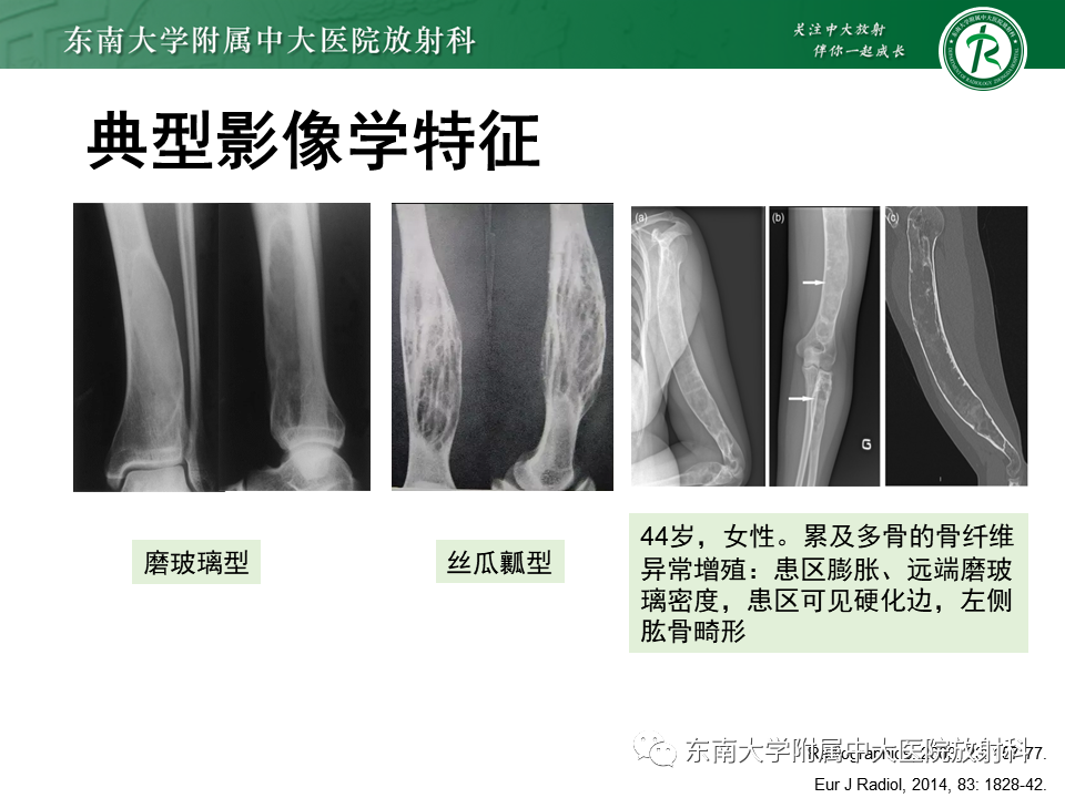 【PPT】骨纤维异常增殖症-14