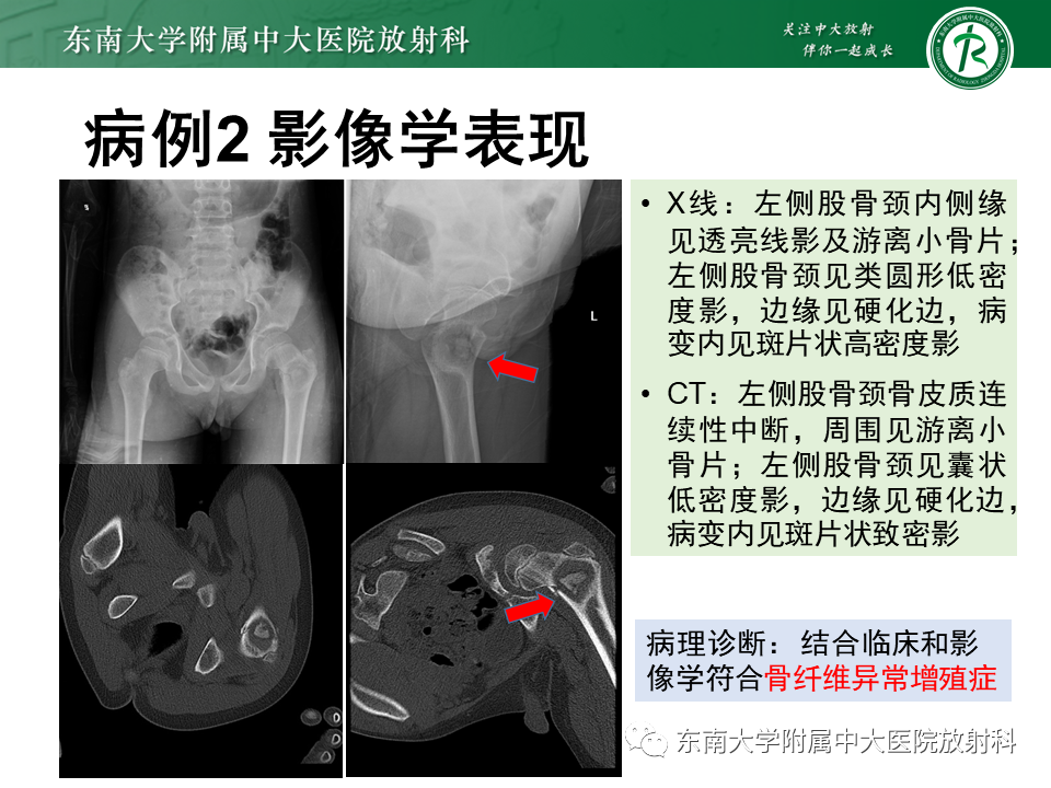 【PPT】骨纤维异常增殖症-16