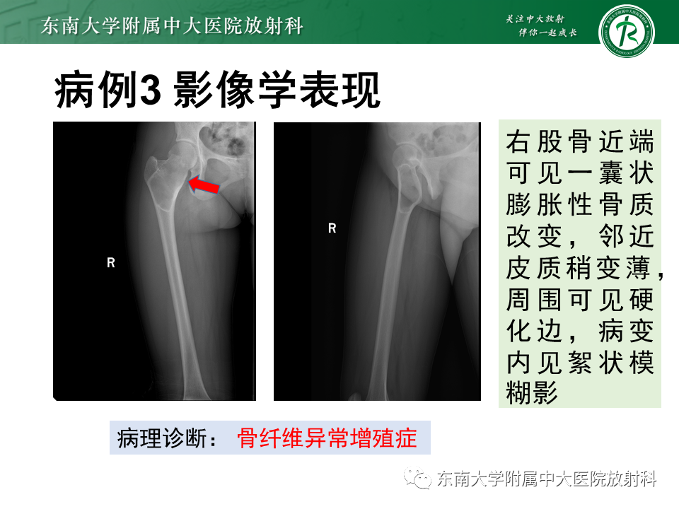 【PPT】骨纤维异常增殖症-18