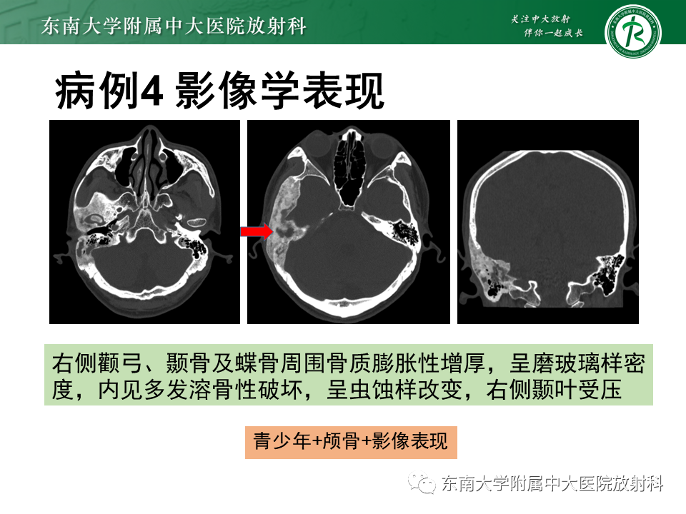 【PPT】骨纤维异常增殖症-20