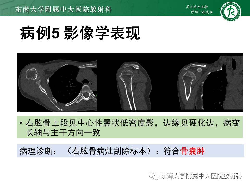 【PPT】骨纤维异常增殖症-24