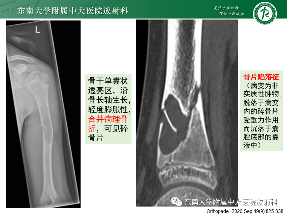 【PPT】骨纤维异常增殖症-26