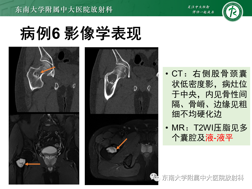 【PPT】骨纤维异常增殖症-28