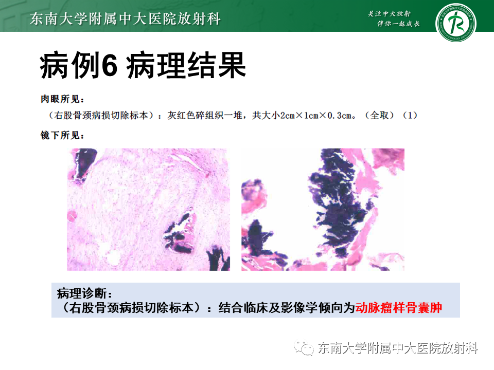 【PPT】骨纤维异常增殖症-29