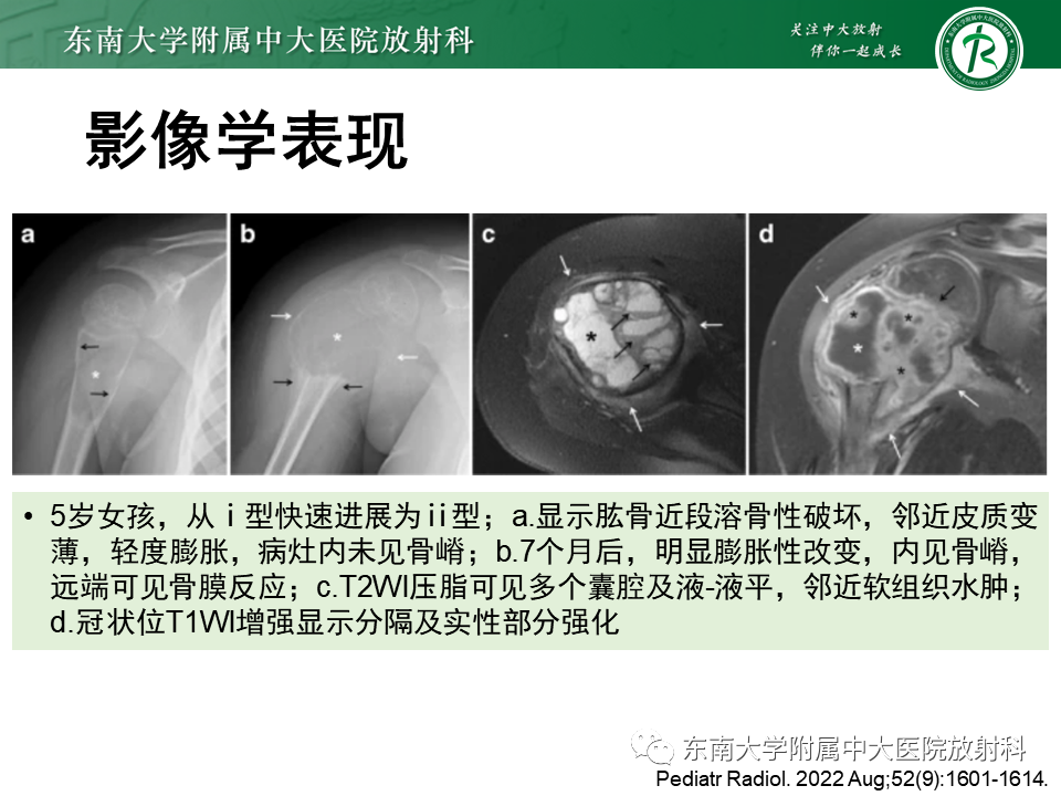【PPT】骨纤维异常增殖症-32