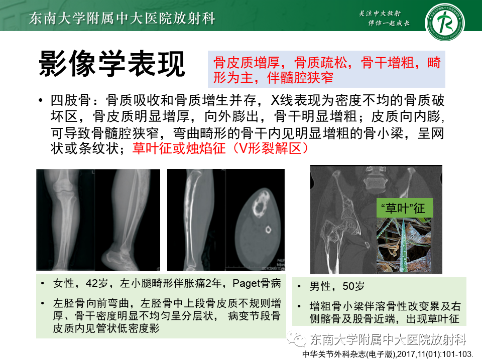 【PPT】骨纤维异常增殖症-34