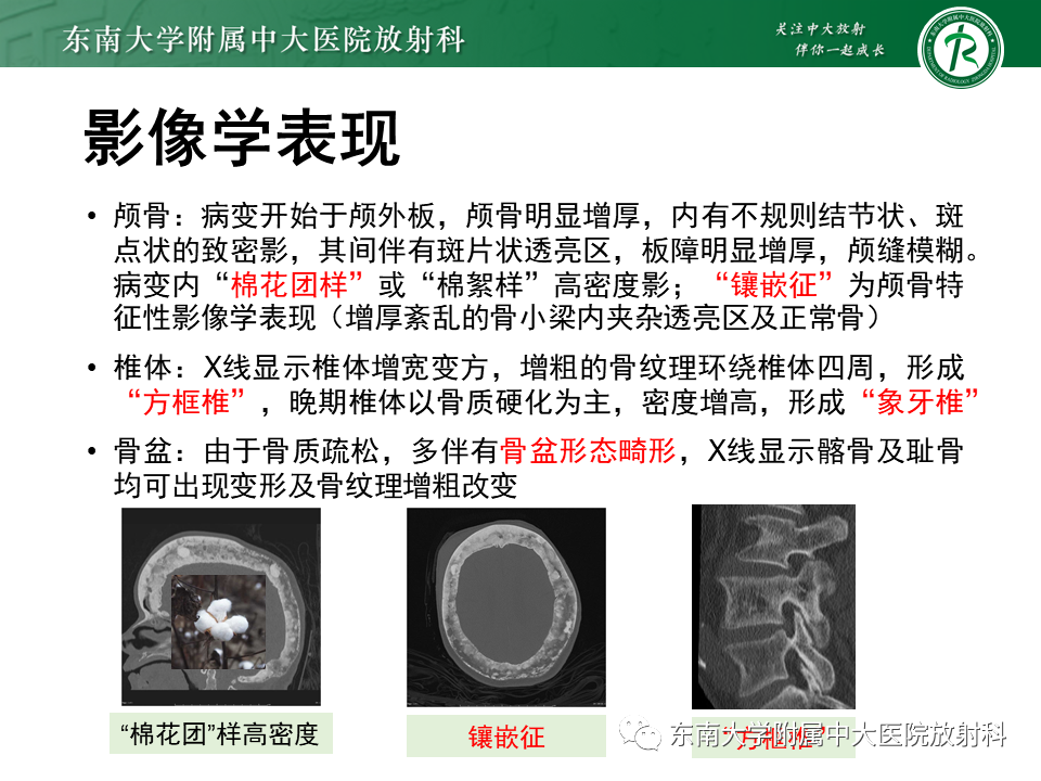 【PPT】骨纤维异常增殖症-35