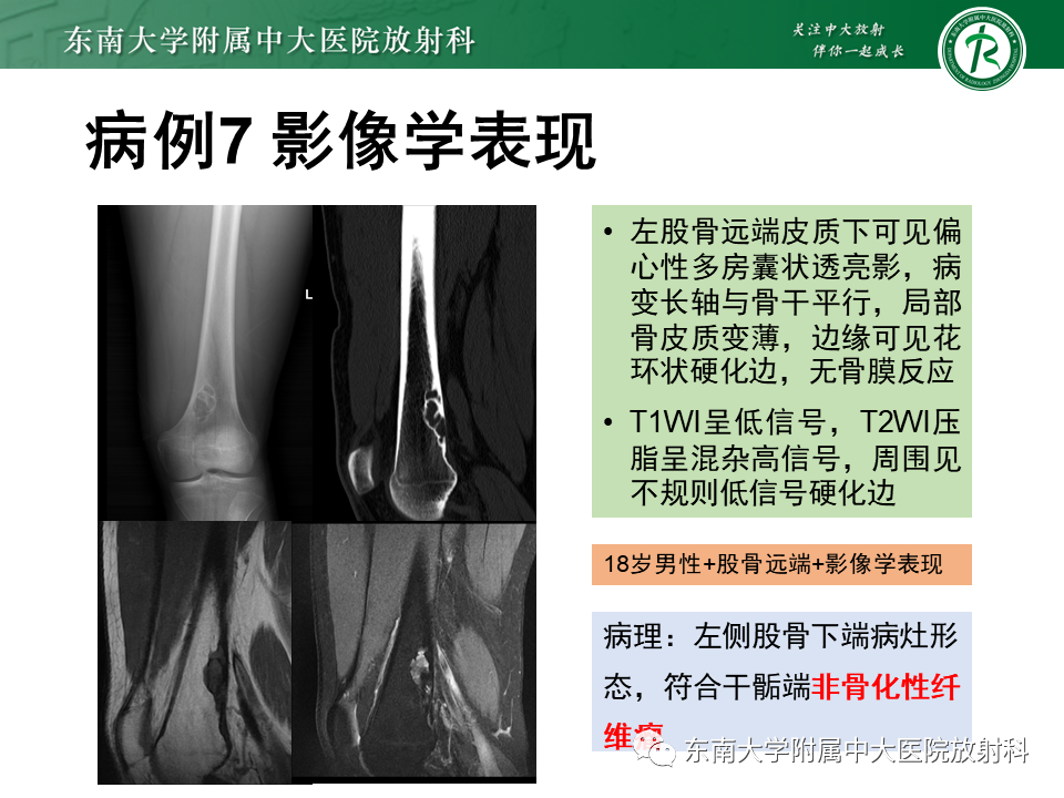 【PPT】骨纤维异常增殖症-38