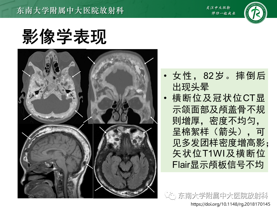 【PPT】骨纤维异常增殖症-36